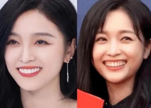 吴宣仪牙齿前后对比 吴宣仪牙齿怎么回事？ 背后真相实在令人震惊