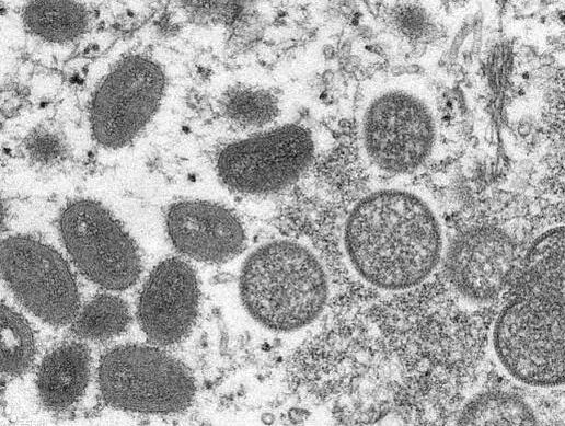 猴痘密接者需进行21天健康监测  背后真相实在令人感到惊愕