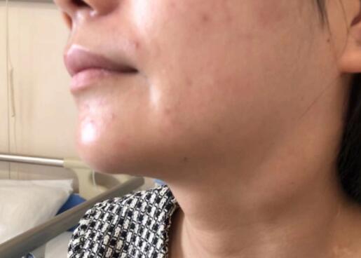 少女连续数日高烧不退确诊接吻病  背后真相实在令人感到惊愕