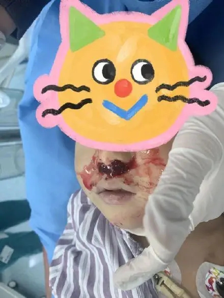 奶奶向3岁男童鼻腔塞头发止血 背后真相实在令人感到惊愕