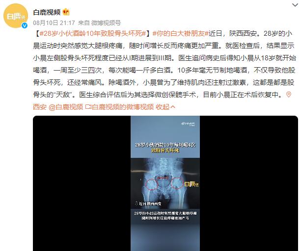 28岁小伙酒龄10年致股骨头坏死 一周至少喝三四次