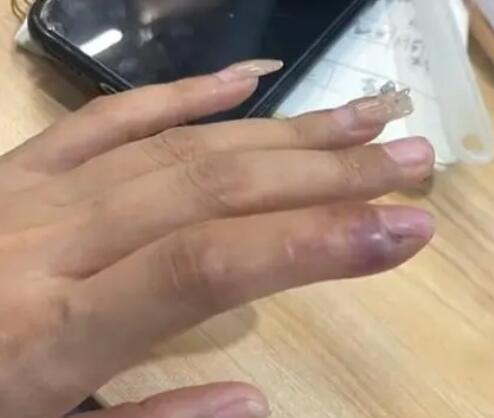 女子拔倒刺致骨髓炎要刮骨手术  内幕曝光简直太意外了