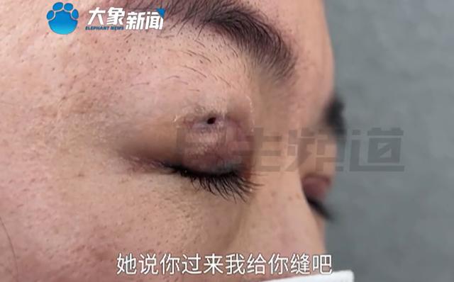 女子双眼皮修复后 闭上眼能看到外面 流眼泪时从洞里流出