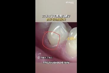 27岁女子长期横向刷牙致牙齿缺损 背后真相实在令人感到惊愕